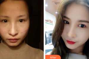 嘉興市曙光中西醫(yī)結(jié)合醫(yī)院整形美容科王良發(fā)整形價(jià)格表附雙眼皮手術(shù)案例展示