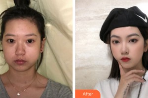 深圳金美人整形外科門診部段國新整形價格表附下頜角手術案例展示