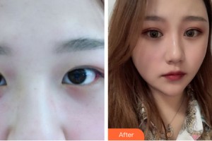 海南伊佳醫(yī)療美容醫(yī)院丁合軍整形價格表附眼部手術案例展示