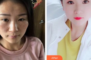 西安光仁醫(yī)院愛斯丁整形中心劉春華整形價格表附皮膚美容案例展示