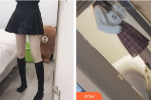 黑龍江解放軍211醫(yī)院整形美容中心龔宇整形價格表附大腿吸脂案例展示