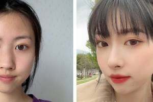 昆明吳氏嘉美美容醫(yī)院吳自強(qiáng)整形價(jià)格表附自體肋軟骨隆鼻案例展示