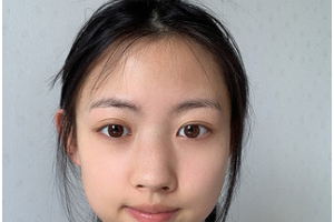 昆明吳氏嘉美美容醫(yī)院李明整形價(jià)格表附鼻修復(fù)案例展示