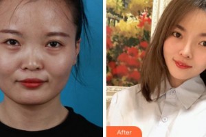 上海解放軍第四五五醫(yī)院激光整形科歸來整形價(jià)格表附臉型（顴骨+下頜角）+鼻部手術(shù)案例展示