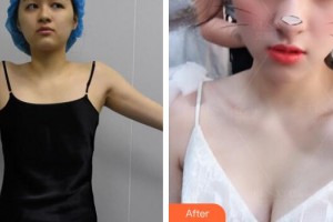 廣州現代醫(yī)院數字化整形美容中心劉濤整形價格表附自體脂肪隆胸案例展示