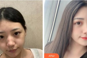 廣州現代醫(yī)院數字化整形美容中心廖曉蕓整形價格表附激光祛斑案例展示