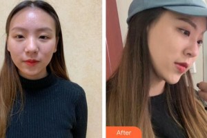 廣州現代醫(yī)院數字化整形美容中心劉志剛整形價格表附自體肋軟骨隆鼻案例展示