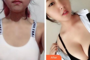 廣州軍頤醫(yī)院整形美容中心楊彥清整形價格表附濃縮豐胸案例展示