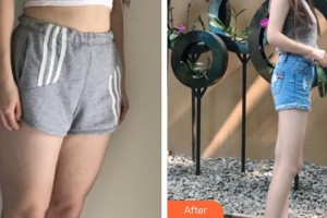 廣州珈禾整形美容門診部李勤整形價格表附吸脂瘦大腿案例展示