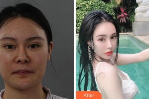 廣州軍區(qū)總醫(yī)院全軍激光整形美容中心余文林整形價格表附下頜角整形案例展示