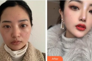 廣州博仕整形美容醫(yī)院謝明英整形價格表附顴骨+下頜角案例展示