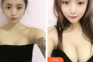 廣州遠東美容醫(yī)院王魁然 教授整形價格表附內窺鏡雙平面假體隆胸案例展示