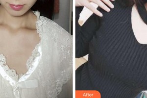 廣州星團醫(yī)學美容門診部楊昆兵整形價格表附假體隆胸案例展示