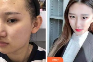 廣州星團(tuán)醫(yī)學(xué)美容門診部廖國善整形價(jià)格表附面部吸脂瘦臉案例展示