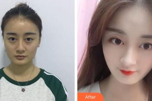 廣州星團(tuán)醫(yī)學(xué)美容門診部劉明整形價(jià)格表附假體隆鼻案例展示