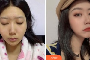 上海仁愛醫(yī)院整形美容科樸宰鉉韓國(guó)頭面部整形專家整形價(jià)格表附顴骨內(nèi)推案例展示