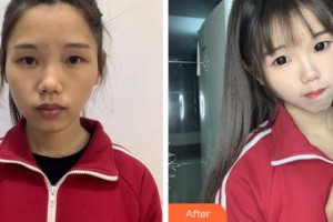 上海仁愛醫(yī)院整形美容科趙軍整形價(jià)格表附面部吸脂案例展示