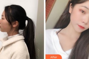 上海仁愛醫(yī)院整形美容科申翰耕韓國(guó)“除皺回春”魔術(shù)師整形價(jià)格表附光子嫩膚案例展示