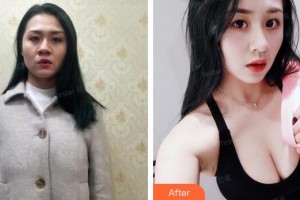 廣州曙光醫(yī)學(xué)美容醫(yī)院劉杰偉整形價(jià)格表附假體豐胸案例展示