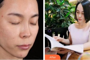 上海仁愛醫(yī)院整形美容科陳峰整形價(jià)格表附面部補(bǔ)水祛皺案例展示