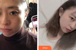 上海天大醫(yī)療美容醫(yī)院朱桂英整形價格表附夢瑤雀斑調(diào)節(jié)方案例展示