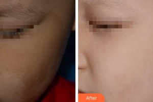 上海仁濟醫(yī)院整形外科邰寧正整形價格表附超激光美膚祛咖啡斑案例展示