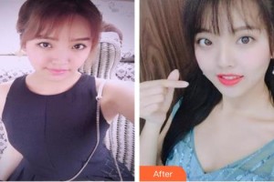 上海時光整形外科醫(yī)院施悅整形價格表附自體脂肪隆胸案例展示