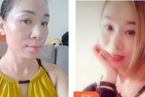 上海時光整形外科醫(yī)院張克敏整形價格表附激光祛斑案例展示