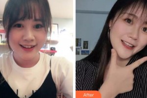 上海時光整形外科醫(yī)院王志遠整形價格表附金屬托槽矯正案例展示