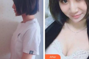 上海天大醫(yī)療美容醫(yī)院陳小偉整形價格表附假體隆胸案例展示