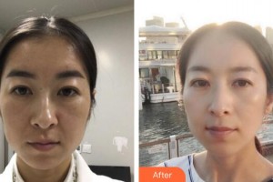 廣州曙光醫(yī)學(xué)美容醫(yī)院單良整形價(jià)格表附熱瑪吉案例展示