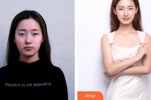 上海華美醫(yī)療美容醫(yī)院田波整形價格表附法國青春動能素補水嫩膚，除皺案例展示