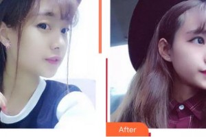 上海萬眾醫(yī)院醫(yī)療美容科金炳國整形價格表附牛奶酸煥膚案例展示