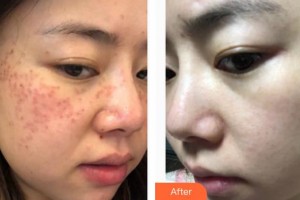 上海美立方整形醫(yī)院馬競整形價格表附祛斑案例展示