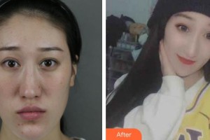 上海美立方整形醫(yī)院洪軍整形價格表附神奇的雙顎畸形矯正術案例展示