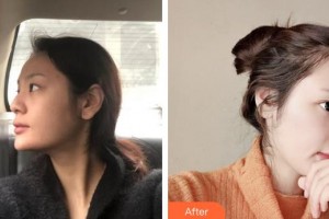 上海華美醫(yī)療美容醫(yī)院李庭勳整形價格表附鼻部手術脂肪填充案例展示