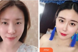 上海華美醫(yī)療美容醫(yī)院文愛克整形價格表附隆鼻手術日記案例展示