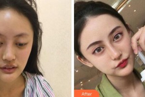 廣州粵秀整形外科醫(yī)院徐士亮整形價(jià)格表附鼻部手術(shù)案例展示