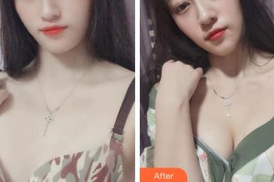 廣州美萊醫(yī)療美容醫(yī)院熊明根整形價(jià)格表附濃縮豐胸案例展示