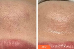 廣州美恩整形美容醫(yī)院黃禮整形價(jià)格表附皮膚深層清潔案例展示