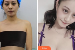 沈陽杏林整形美容醫(yī)院史靈芝整形價格表附假體隆胸，棉花糖假體隆胸案例展示