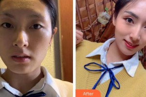 廣州博仕整形美容醫(yī)院李東偉整形價(jià)格表附埋線提升案例展示