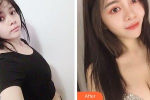 廣州中科美整形醫(yī)院孫中生整形價(jià)格表附假體隆胸案例展示