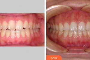 廣州金沙洲醫(yī)院整形科（原白云山）杜本軍整形價(jià)格表附牙齒正畸案例展示