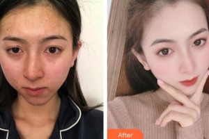 廣州新時(shí)代整形美容醫(yī)院饒曉艷美容皮膚醫(yī)師 咨詢培訓(xùn)師整形價(jià)格表附健康素顏肌案例展示