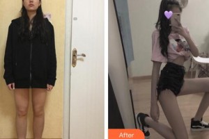 廣州新時(shí)代整形美容醫(yī)院張世東整形價(jià)格表附大腿吸脂案例展示