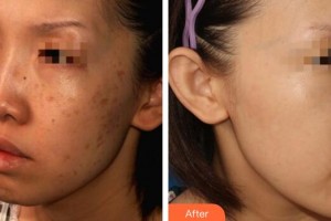 廣州美萊醫(yī)療美容醫(yī)院潘萍整形價(jià)格表附曬斑調(diào)節(jié)案例展示