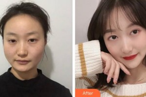 上海麗人整形美容醫(yī)院陳兵整形價格表附下頜角磨骨案例展示