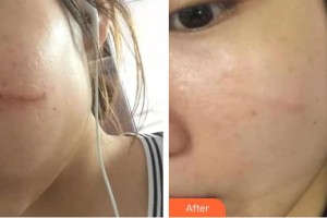 上海仁愛醫(yī)院整形美容科彭才學整形價格表附點陣祛疤痕案例展示