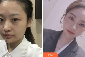 上海麗人整形美容醫(yī)院范鑫整形價格表附超激光美膚祛斑 美白案例展示